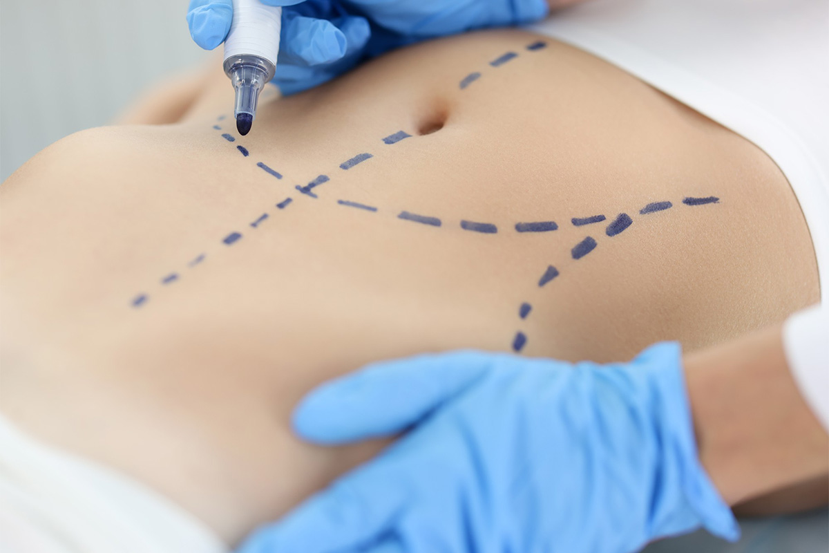 Poliklinika Beograd | Liposukcija stomaka